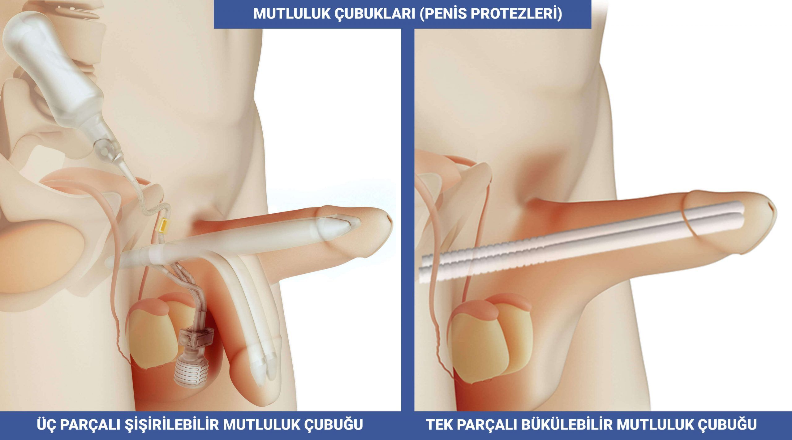 Mutluluk Cubuğu - Penil Protezi - Penis Protezi Çesitleri Modelleri - Üc Parçalı Şişirilebilir ve Tek Parşalı Bukulebilir Malleable Protez