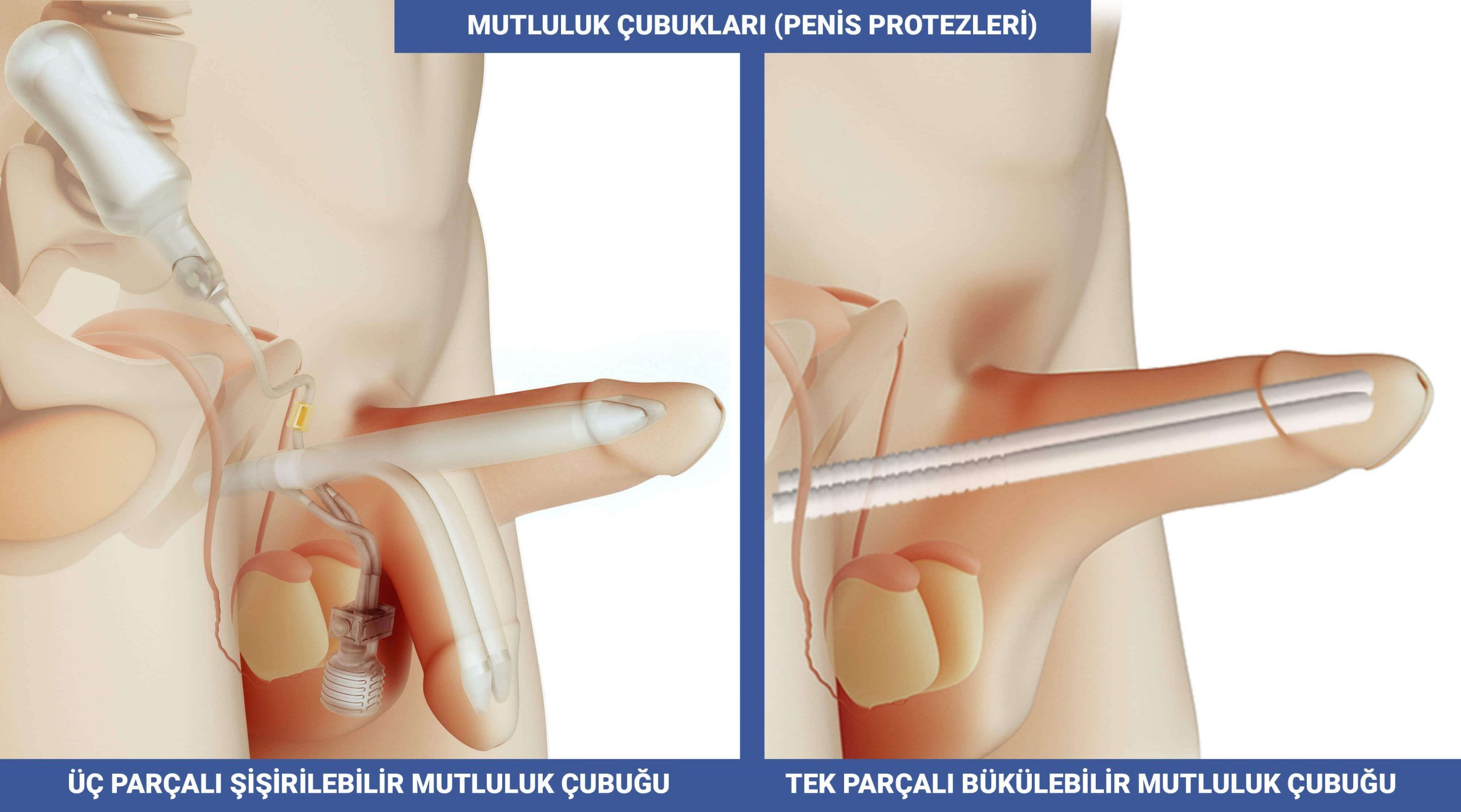 Penis Protezi - Penil Protez - Penis Protezi Çesitleri Modelleri - Üc Parçalı Şişirilebilir ve Tek Parşalı Bukulebilir Malleable Protez