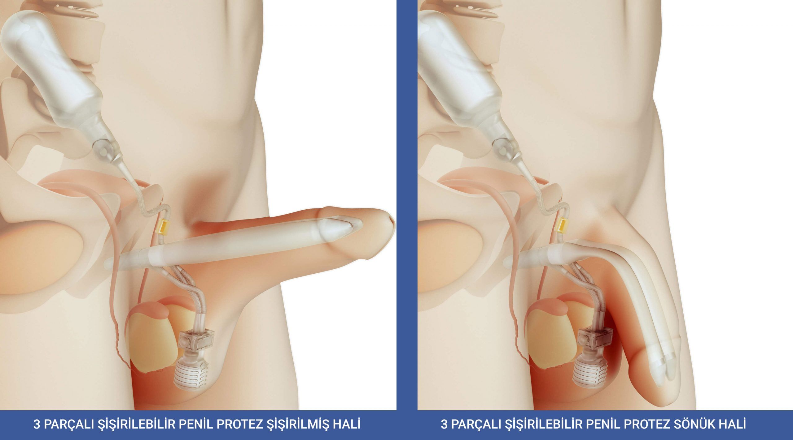 3 Parçalı Şişirilebilir Penil Protezler